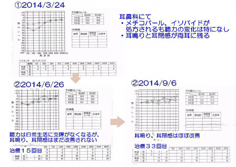 心因性難聴 107A56 | medu4でゼロから丁寧に医学を学ぶ